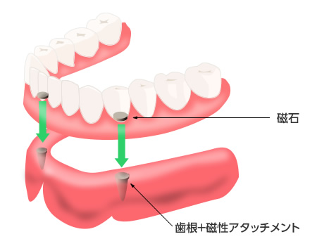 マグネット義歯説明図